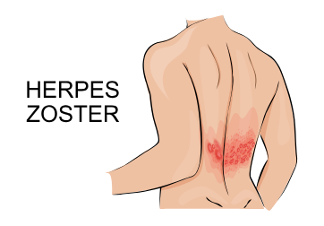 Herpes Zoster und seine 30 unerforschten Varianten